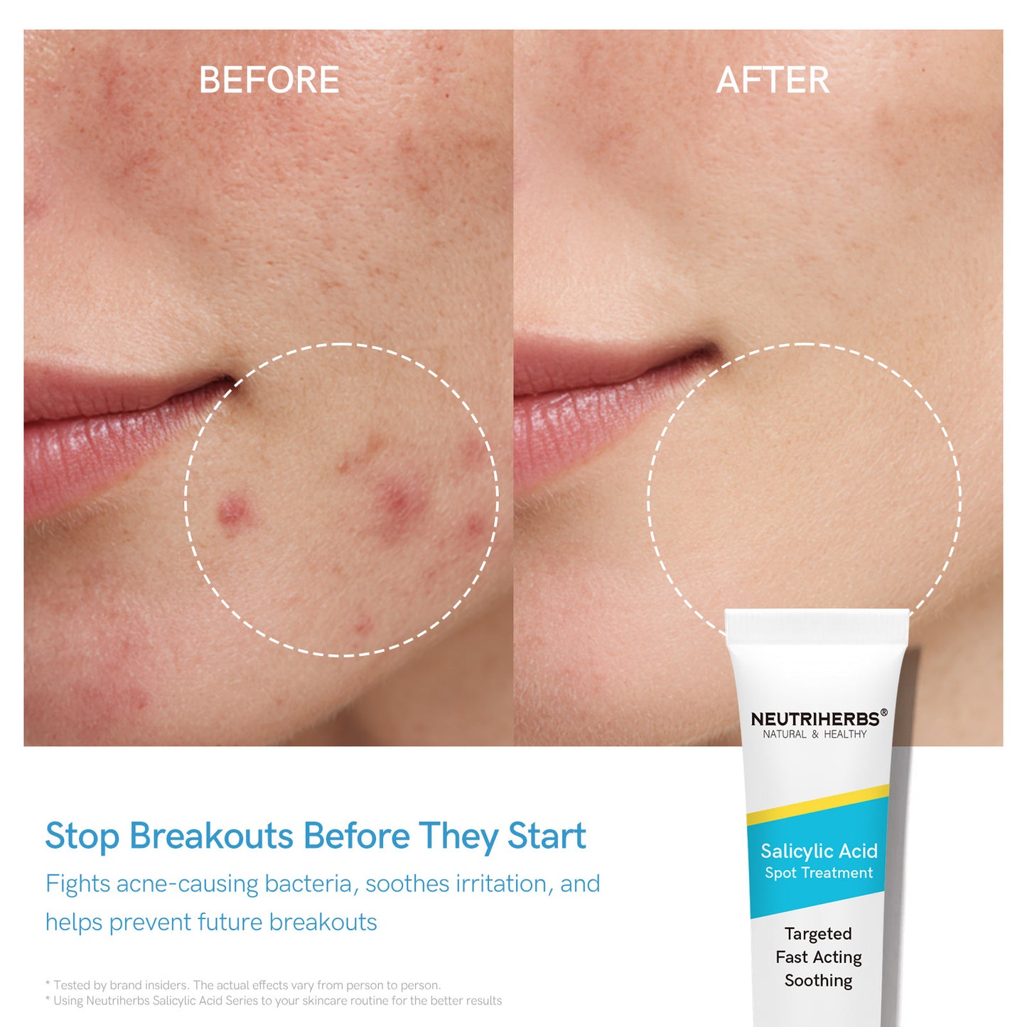 Salicylic Acid Spot Treatment for Acne & Blemishes