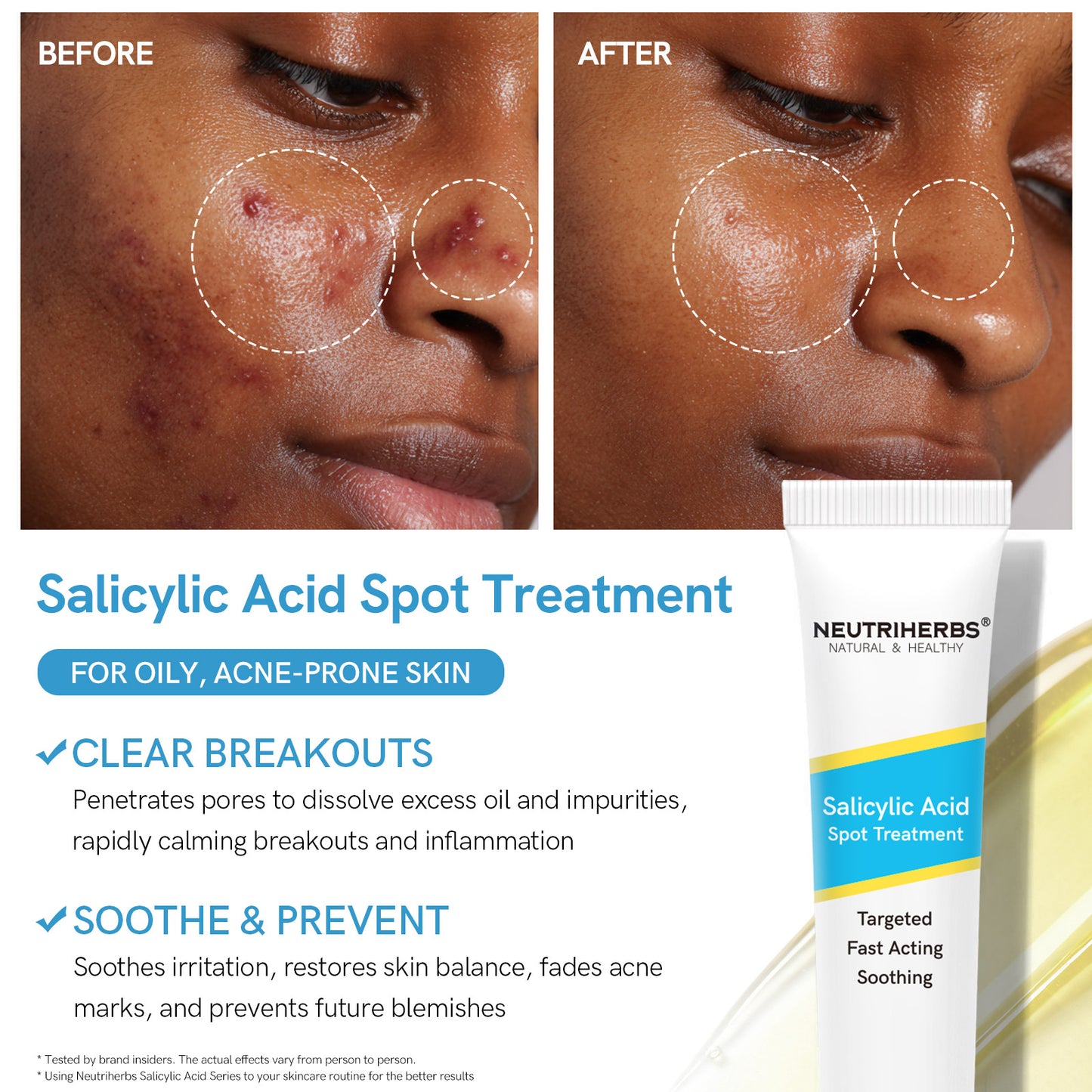 Salicylic Acid Cream & Cleanser & Treatment