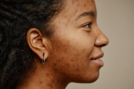 Dark Marks on the Body: The Ultimate SA Treatment Guide