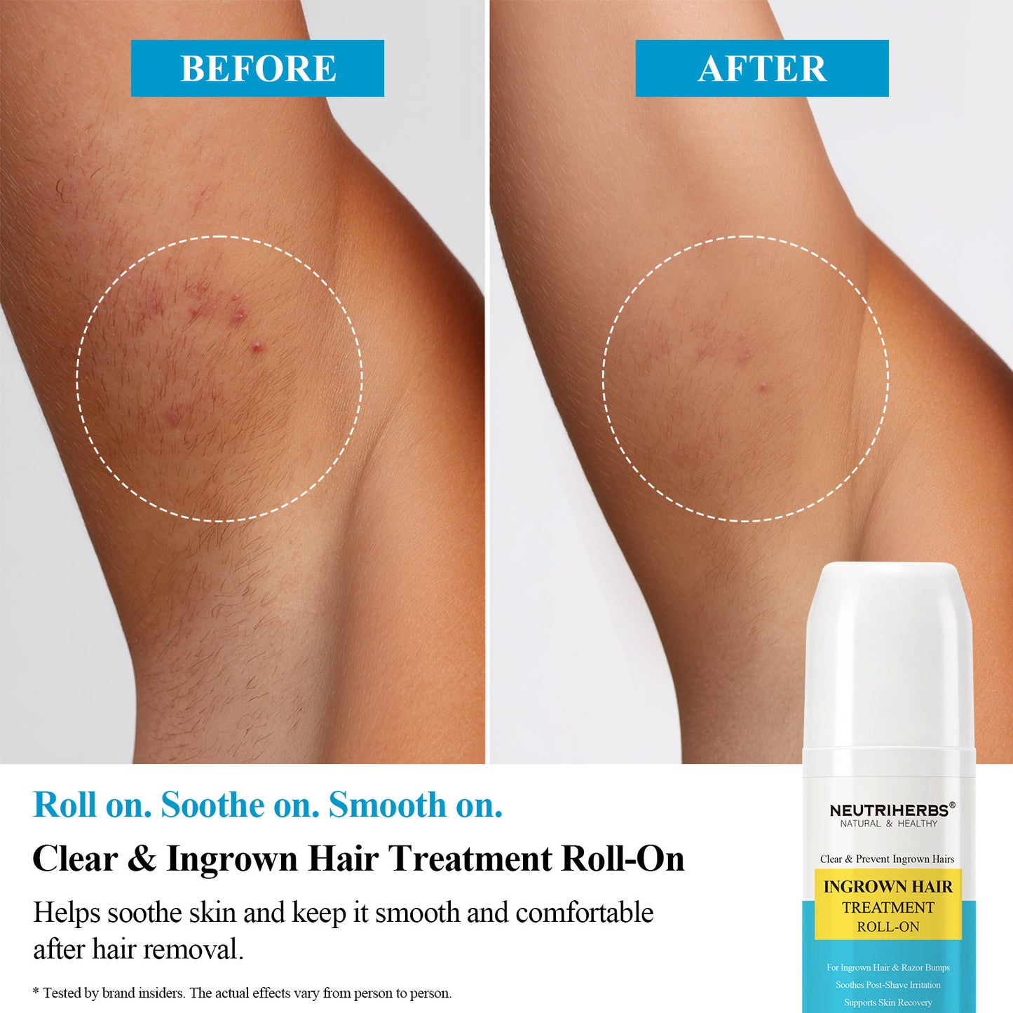 Neutriherbs Clear & Prevent Ingrown Hairs Ingrown Hair Treatment Roll-On