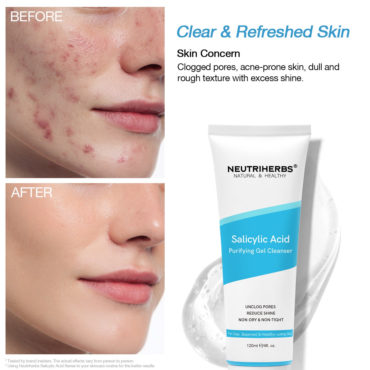 Salicylic Acid Cream & Cleanser & Treatment
