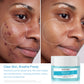 Salicylic Acid Face Cream for Acne & Oil Control