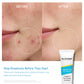 Salicylic Acid Spot Treatment for Acne & Blemishes