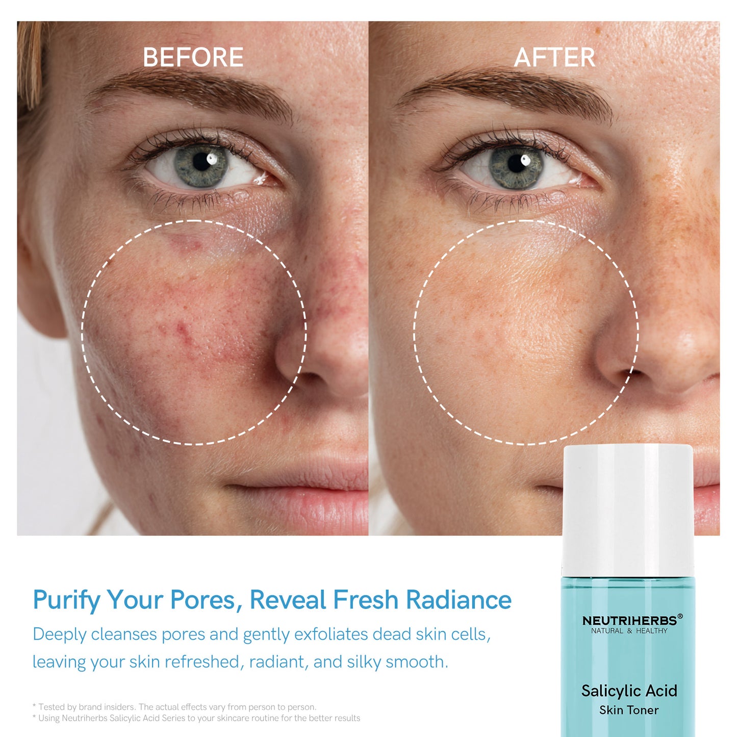 Salicylic Acid Toner for Acne & Pores