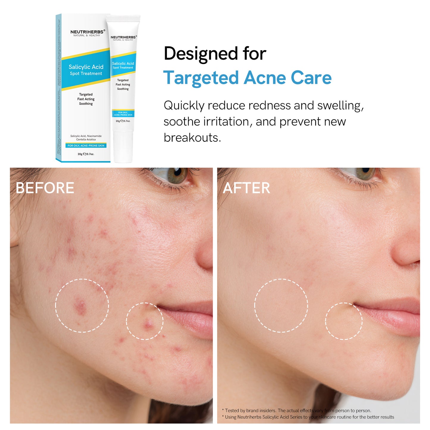 Neutriherbs Salicylic Acid Oil Balance & Acne Control Set for Oily Skin and Breakouts
